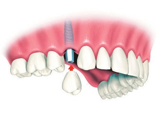 Implantat mit Aufbau Foto: GZFA Implantat mit Aufbau Foto: GZFA
