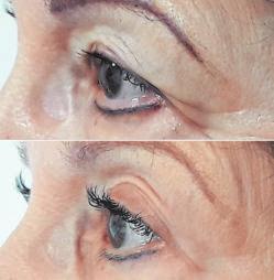 Mithilfe der Plasma-Technologie ist eine Lidstraff ung ohne OP möglich. Das aktuelle Angebot beginnt bei 397 statt 549 Euro. Eine Erstberatung ist natürlich kostenlos Fotos: privat Mithilfe der Plasma-Technologie ist eine Lidstraff ung ohne OP möglich. Das aktuelle Angebot beginnt bei 397 statt 549 Euro. Eine Erstberatung ist natürlich kostenlos Fotos: privat