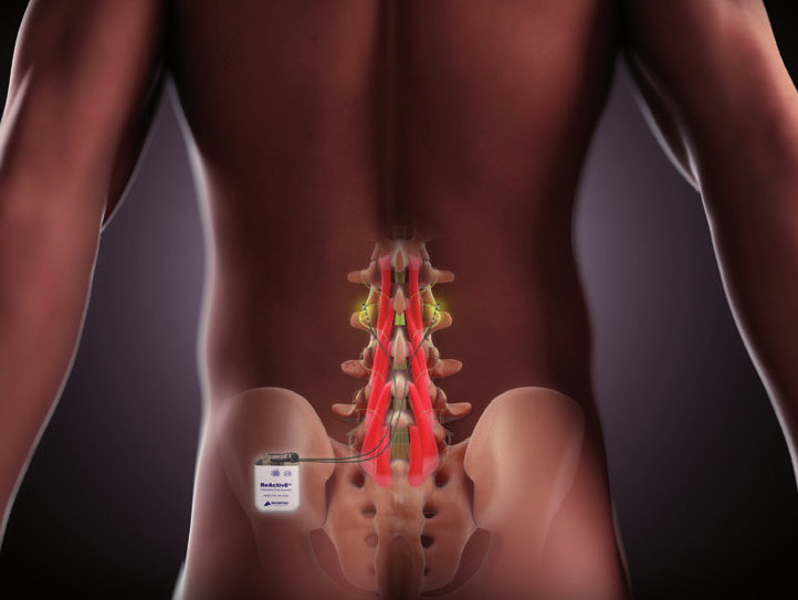 Das ReActiv8®-System aktiviert die Tiefenmuskulatur im unteren Rücken FOTO: ©MAINSTAY MEDICAL INTERNATIONAL PLC