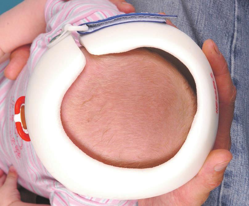 Helmtherapie MKG Diakonie Klinikum Siegen