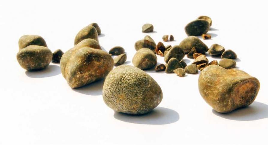 Gallensteine – Schmerzen ernst nehmen Image 1 Gallensteine – Schmerzen ernst nehmen Image 1