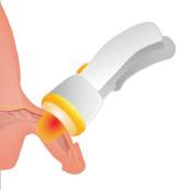 Prinzip der Stoßwellentherapie am Penis Prinzip der Stoßwellentherapie am Penis